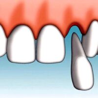 DENTAL AVULSION