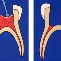 pulpectomy